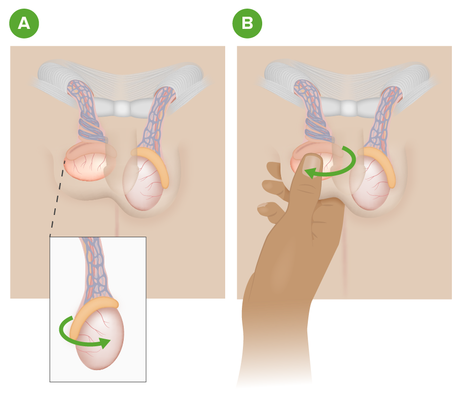 torsione del testicolo